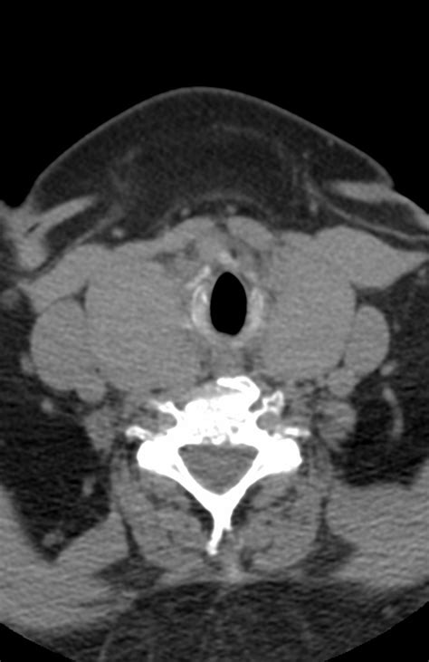 Intrathoracic Goiter Neurorad911 Intrathoracic Goiter