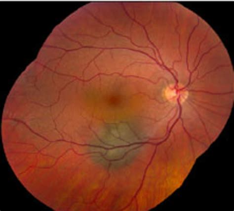Choroidal Nevus Montage Image Of The Right Eye Showing A Pigmented