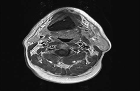 Giant Trichilemmal Cyst Of The Submental Region Journal Of
