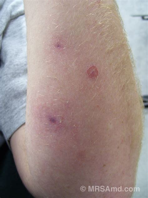 Mrsa Pictures Staph Infection Picturesgraphic Images Mrsa Md