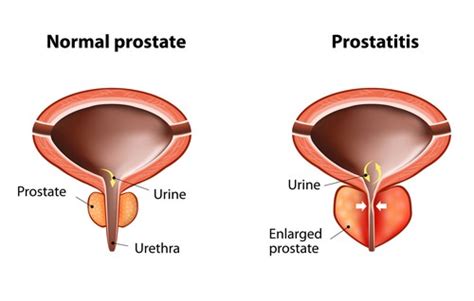 Prostatitis Symptoms Complications And Treatment
