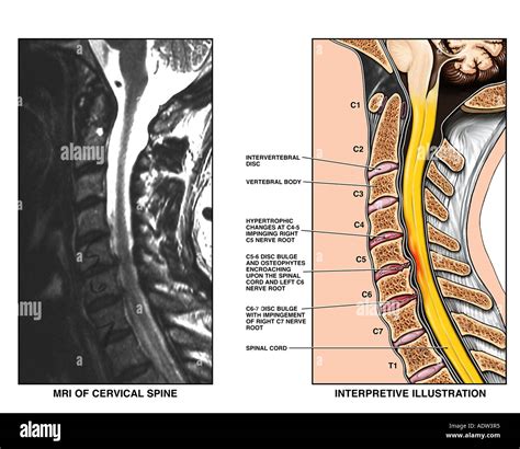 Cervical Disk Bulge Mri Hi Res Stock Photography And Images Alamy