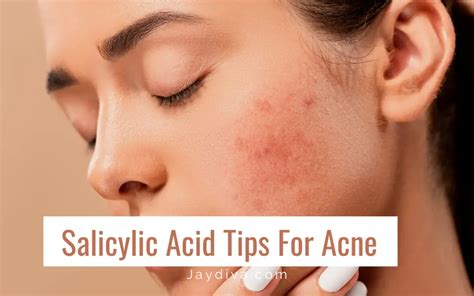 How To Use Salicylic Acid For Acne The Right Way Jaydiva