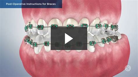 guide to braces cooper orthodontics houston texas
