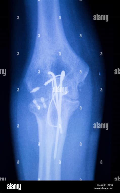 Elbow Joint Titanium Metal Modern Implant X Ray Test Scan Result After