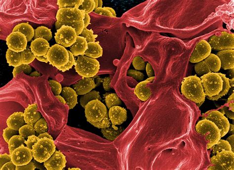 Si tratta di infezioni causate dallo staphylococcus aureus che possono essere . Antibiotici: 1 su 2 inefficace. All'orizzonte infezioni ...