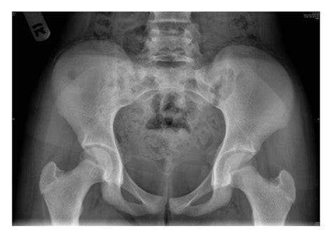 X Ray Ap View Of The Pelvis Showing Hard To Pick Changes In The Right