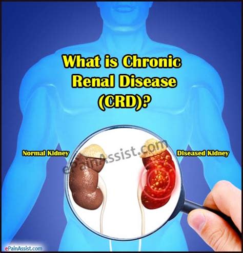 Chronic Renal Diseasepathophysiologycausesstagessymptomsdiagnosis