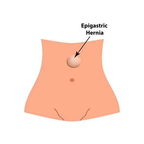 Signs Of Epigastric Hernia Hot Sex Picture
