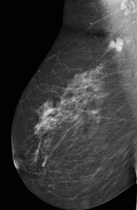 Lymph Nodes On Mammogram Of The Right Breast Image