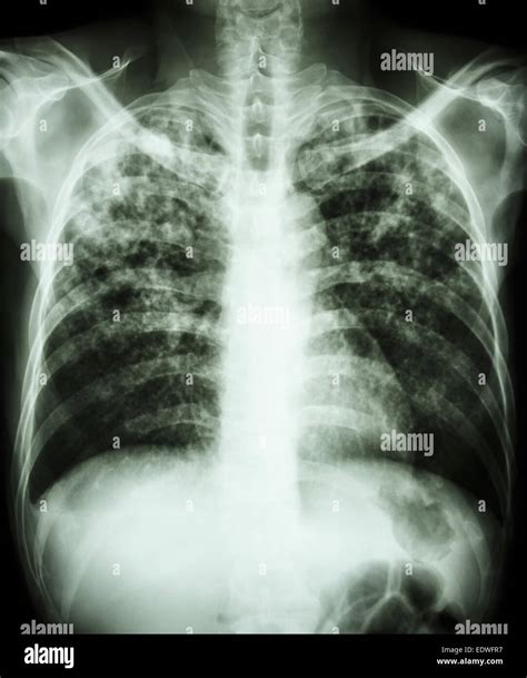 Pulmonary Tuberculosis Film Chest X Ray Show Interstitial