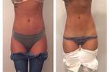 Pictures of Laser Lipo Treatment Side Effects
