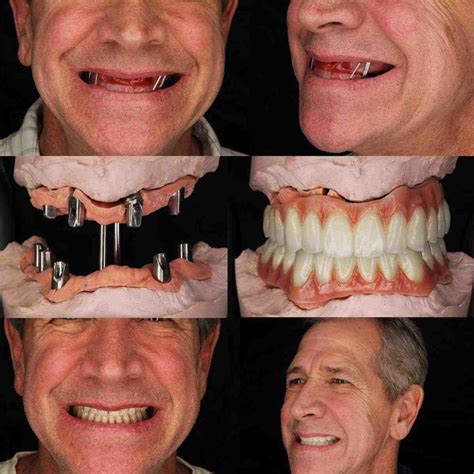 How Much Does A Full Mouth Of Dental Implants Cost