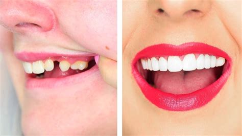 Instant Perfect Smile Upper And Lower Clipsnap On Veneers For Perfect T