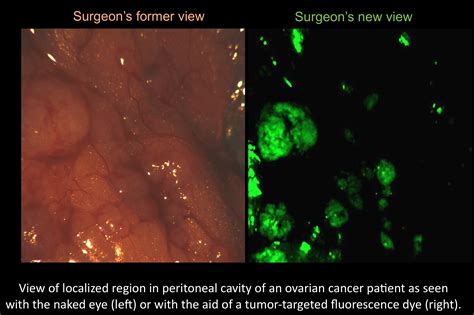 Purdue Technology Used In First Fluorescence Guided Ovarian Cancer Surgery