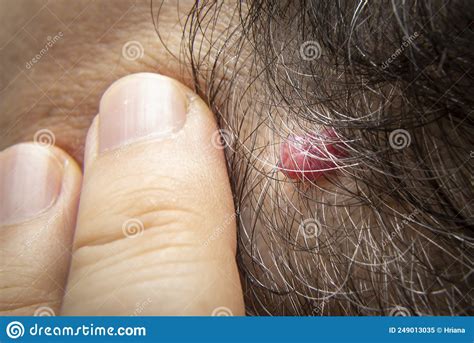 Angioma On The Skin Red Moles On The Body Many Birthmarks Royalty