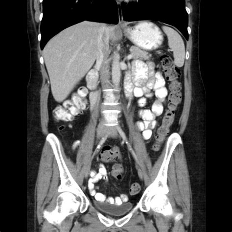 Normal Ct Scan Abdomen