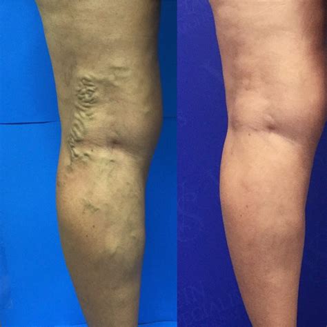 Before And After Vein Treatment Photos Vein Specialists Of The Carolinas