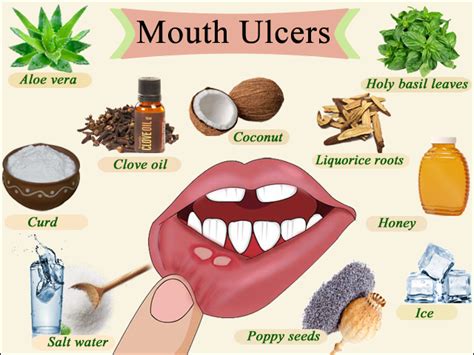 They're rarely a sign of anything serious, but may be uncomfortable to live with. Home Remedies for mouth ulcers | Best home remedis for ...