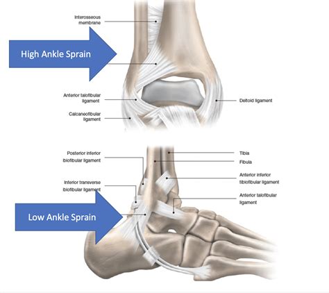 High Ankle Sprain Sprained Ankle Syndesmotic Dr Justin Dean