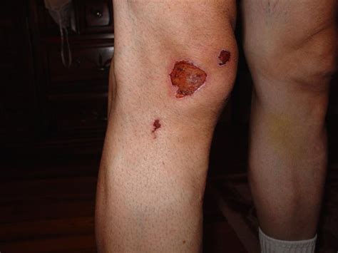 Road rash, one may experience prolonged bleeding, pussing, and uncomfortable stinging. Why you should always wear a bicycle helmet