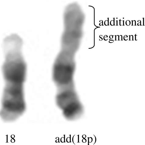 Partial G Banded Karyotype Of Chromosome 18 On The Left Is Shown The