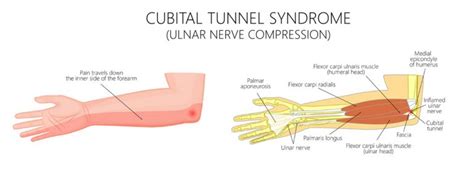 Cubital Tunnel Syndrome Nonsurgical Options