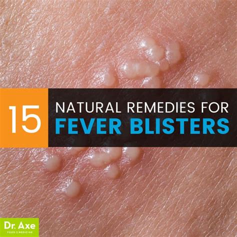 Fever Blister Causes 15 Natural Remedies Dr Axe