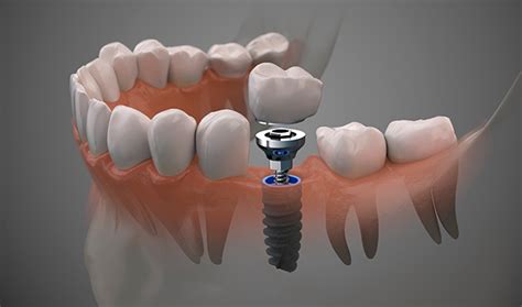 As Es Una Cirug A De Implantes Dentales Cl Nica Oliver Coll