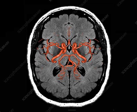 Brain Arteries 3d Mri Scan Stock Image C0489324 Science Photo