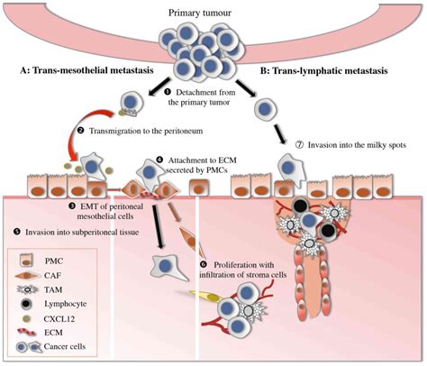 Mechanisms Of Peritoneal Dissemination In Gastric Cancer Review