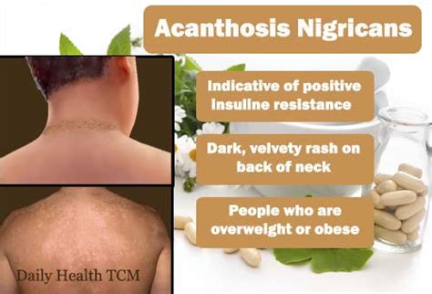 Acanthosis Nigricans Laser Treatment Pregnant Center Informations