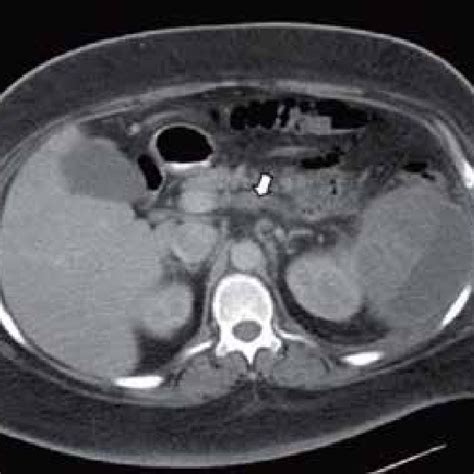 Ct Scan Showing Evidence Of Splenic Infarction Complicated By Abscess