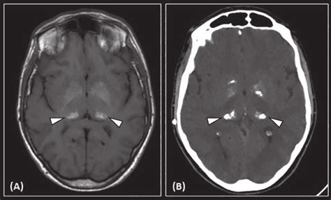Fabry Disease Mri A And Ct B Reveal T1 Hyperintensities A And