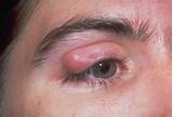 Eye Granuloma Treatment Images