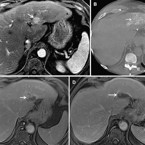 A Contrast Enhanced Mri Showing Arterial Hyperenhancing Lesion Arrow