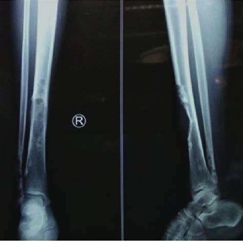 Ap And Lat Plain Radiograph Of Distal Leg And Ankle Joint Showing