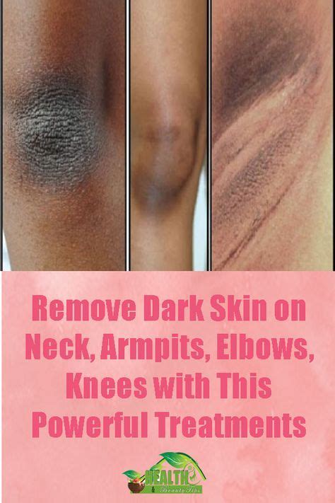 A Lot Of People Have This Issue With Dark Skin Areas And This Is Normal