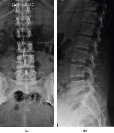 Thoracic And Lumbar Spine Radiology Key