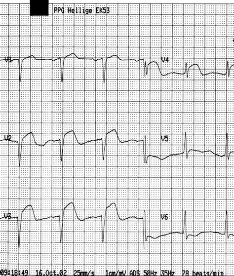 The Patients Ecg Precordial Leads Showing St Elevation During The