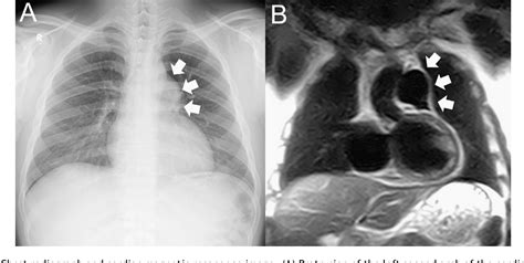 Figure 1 From A Case Of Idiopathic Dilatation Of The Pulmonary Artery