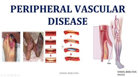 Peripheral Vascular Diseases Arterial Embolism Deep Vein Thrombosis