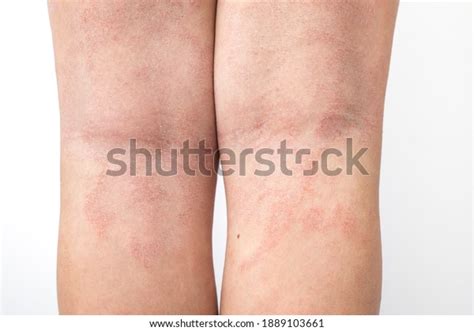 Acute Atopic Dermatitis On Legs Behind Stock Photo Edit Now 1889103661