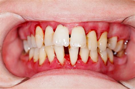 Telltale Signs Of Gum Disease