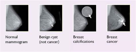 Pictures Of Breast Cancer Lumps Early Breast Cancer Signs To Look For