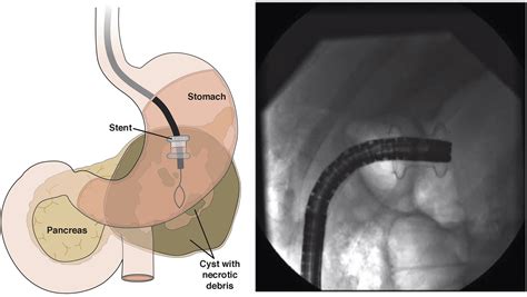 Endoscopic Drainage Of Pancreatic Fluid Collections Clinical Gastroenterology And Hepatology