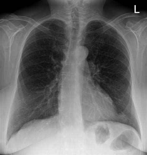 Woman63permanent Cough Aortic Knob Prominent What Else Radiology