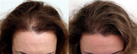 Hair Loss Hairstyles Female Scielo Brasil Female Pattern Hair Loss A Clinical And