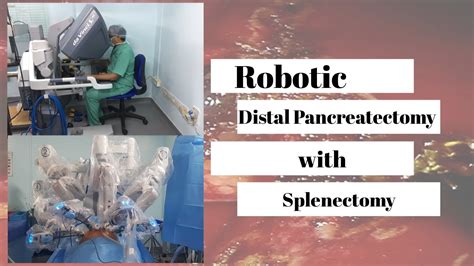 Robotic Distal Pancreatectomy With Splenectomy Step By Step With