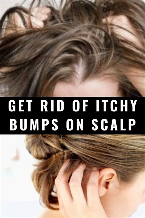 Get Rid Of Itchy Bumps On Scalp Itchy Bumps Scalp Bumps Scalps